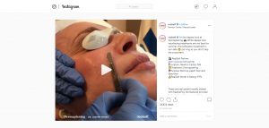 A Time-Lapsed Look at Dermaplaning