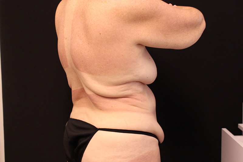 Liposuction Before & After Image