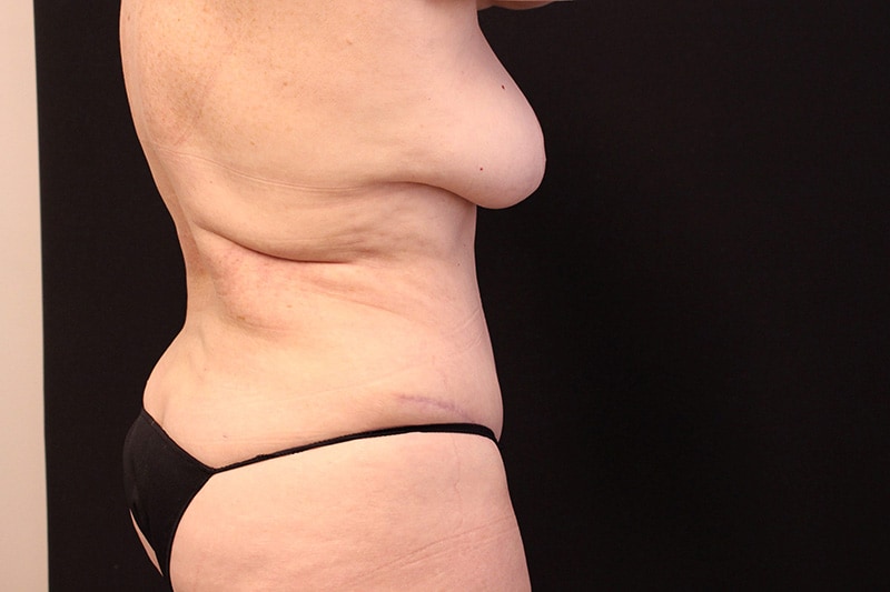 Liposuction Before & After Image