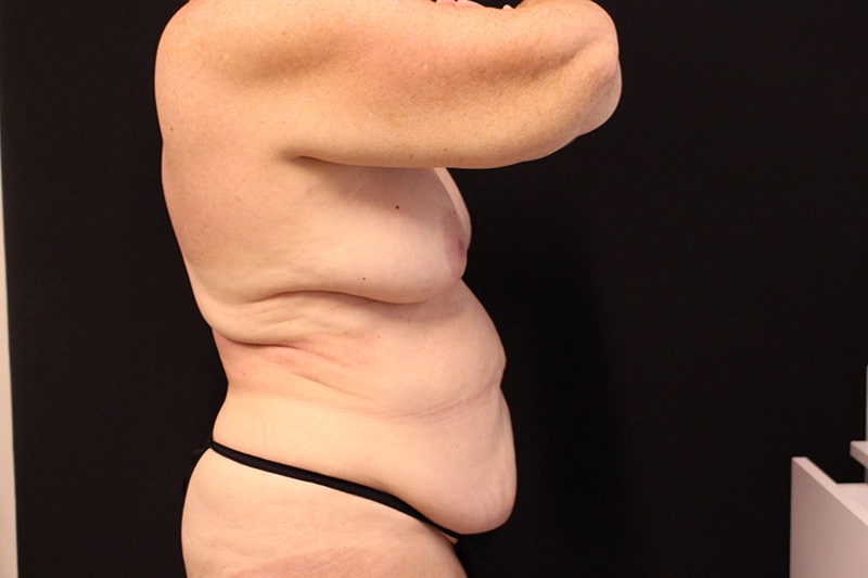 Liposuction Before & After Image