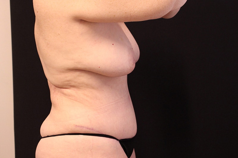 Liposuction Before & After Image