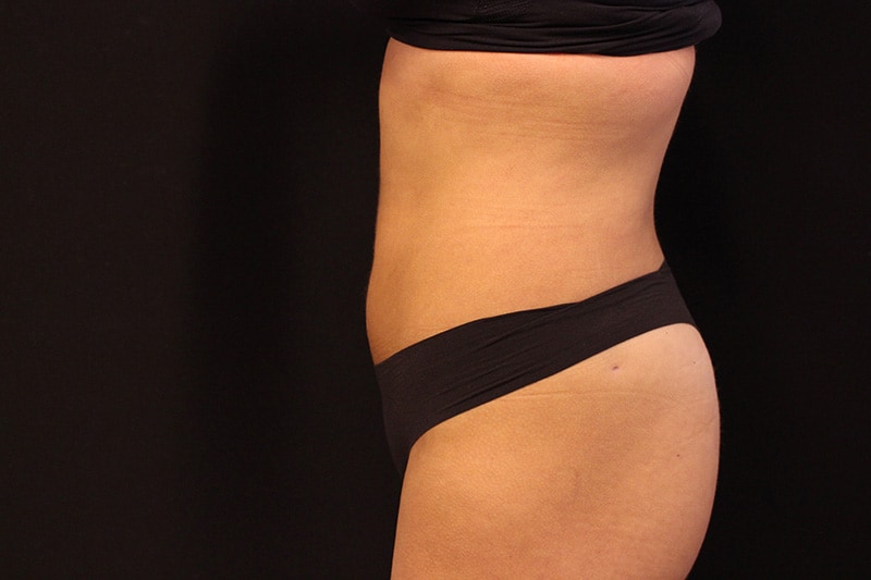 Liposuction Before & After Image