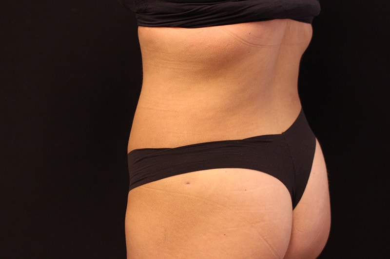 Liposuction Before & After Image