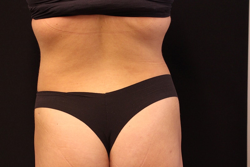 Liposuction Before & After Image