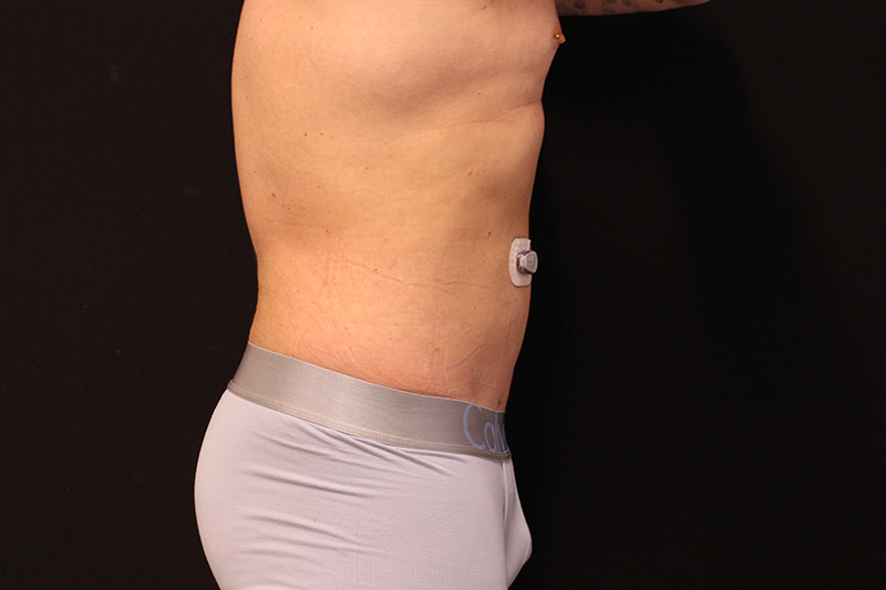 Liposuction Before & After Image