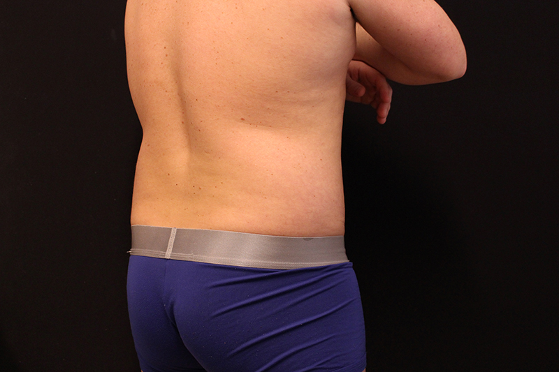 Liposuction Before & After Image