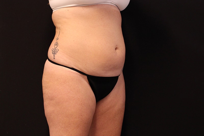 Liposuction Before & After Image