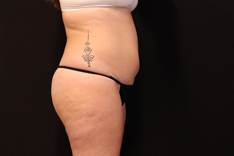 Liposuction Before & After Image