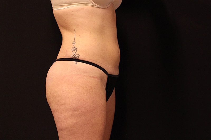 Liposuction Before & After Image