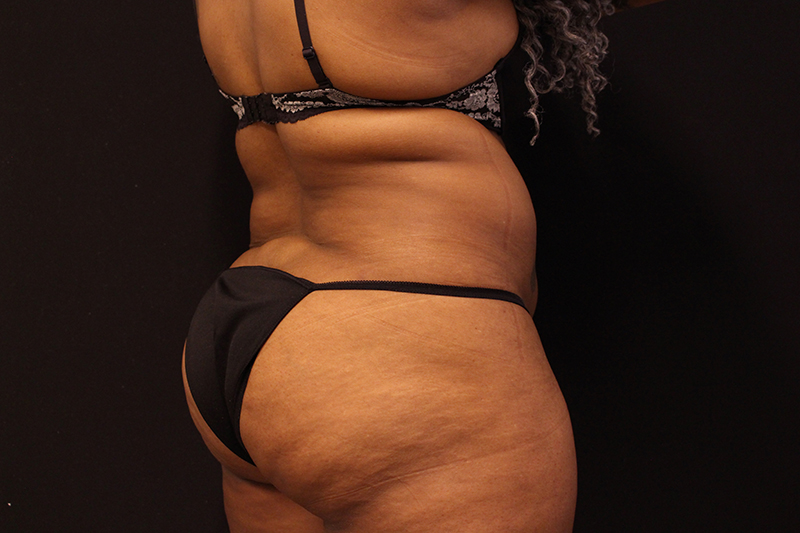 Liposuction Before & After Image