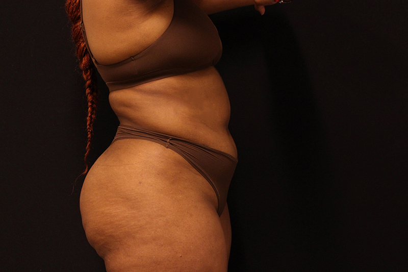 Liposuction Before & After Image