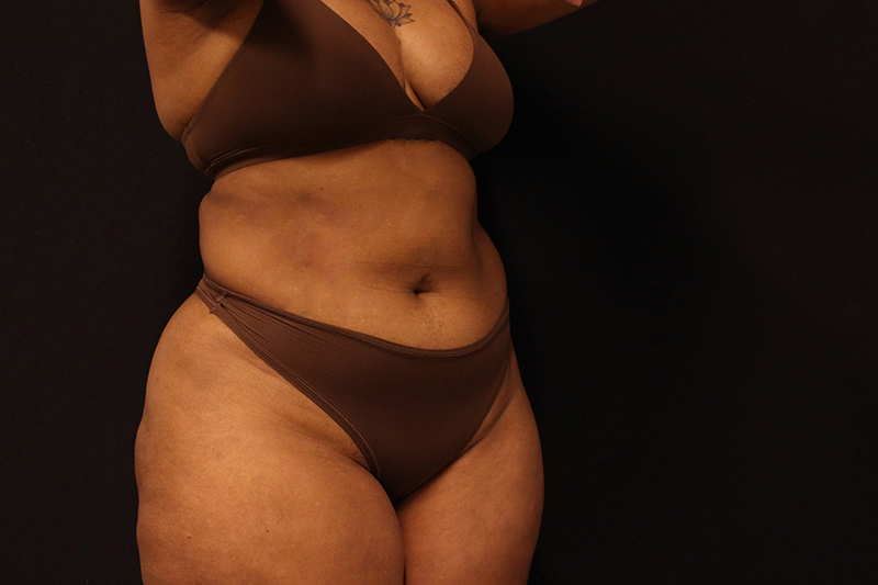 Liposuction Before & After Image