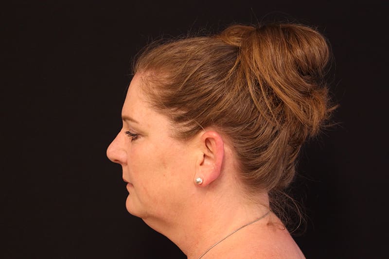 Liposuction Before & After Image
