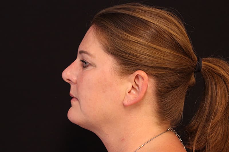 Liposuction Before & After Image