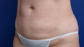 Liposuction Before & After Image