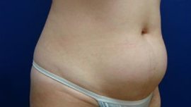 Liposuction Before & After Image
