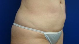 Liposuction Before & After Image