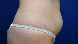 Liposuction Before & After Image