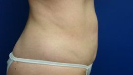 Liposuction Before & After Image