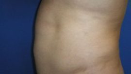 Liposuction Before & After Image