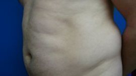 Liposuction Before & After Image
