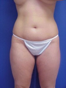 Liposuction Before & After Image