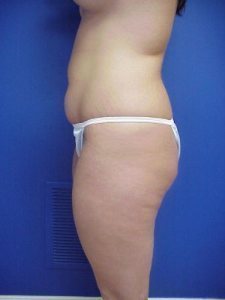 Liposuction Before & After Image