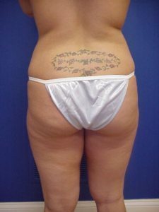 Liposuction Before & After Image