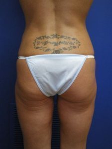Liposuction Before & After Image