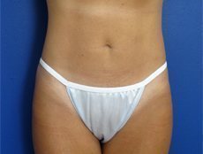 Liposuction Before & After Image
