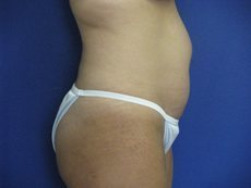 Liposuction Before & After Image