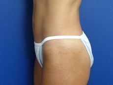 Liposuction Before & After Image