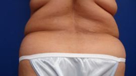 Liposuction Before & After Image