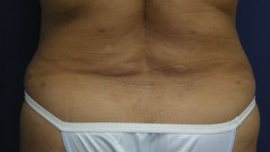 Liposuction Before & After Image