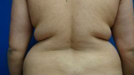 Liposuction Before & After Image