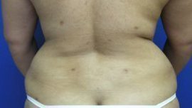 Liposuction Before & After Image
