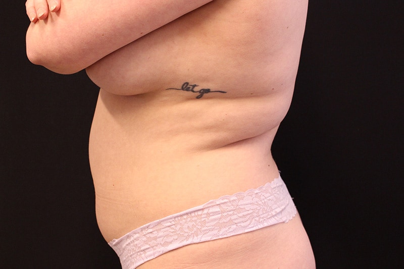 Tummy Tuck Before & After Image