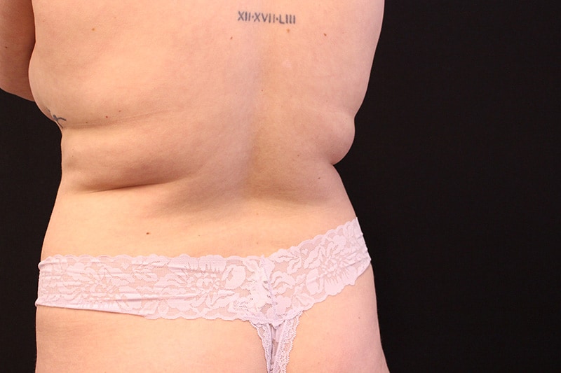 Tummy Tuck Before & After Image