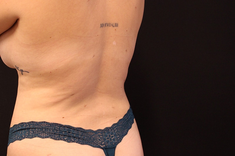 Tummy Tuck Before & After Image