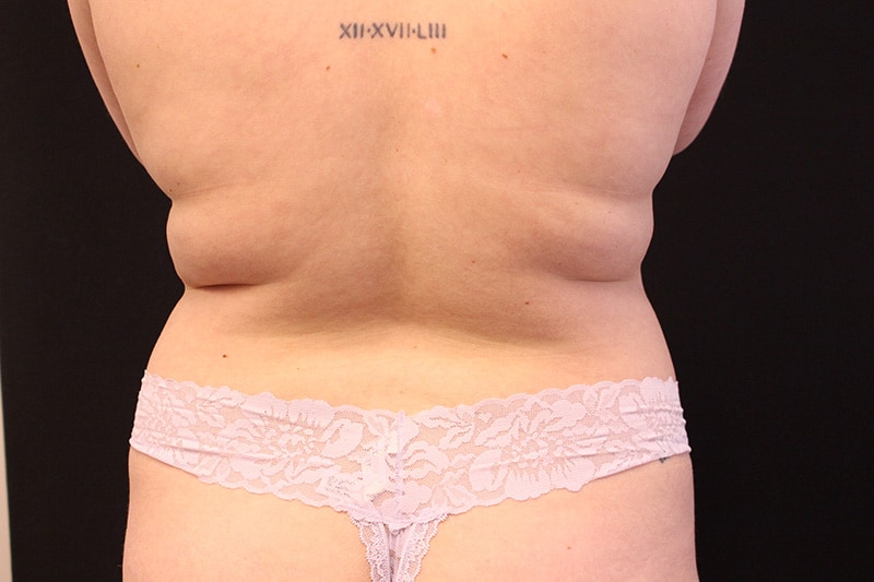Tummy Tuck Before & After Image