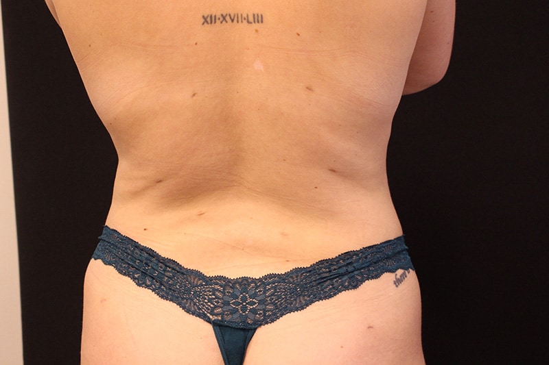 Tummy Tuck Before & After Image