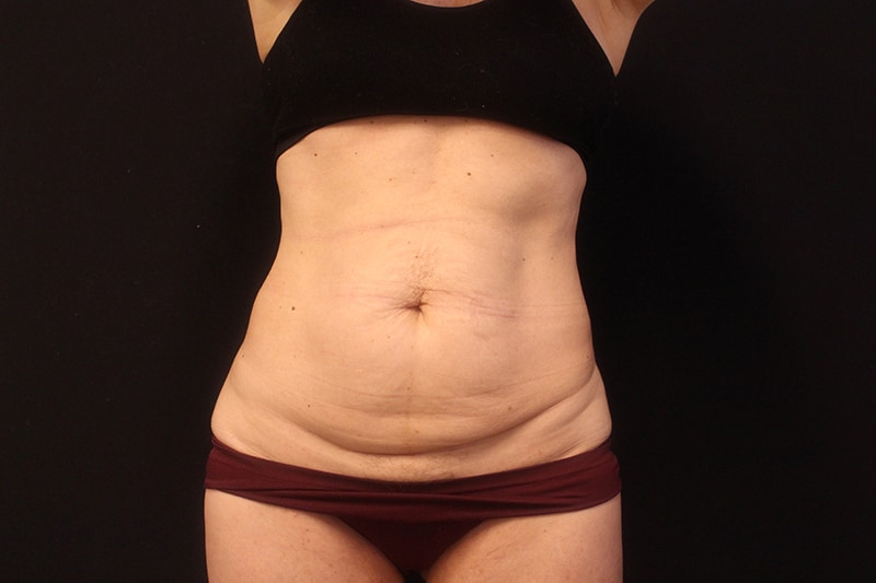 Tummy Tuck Before & After Image
