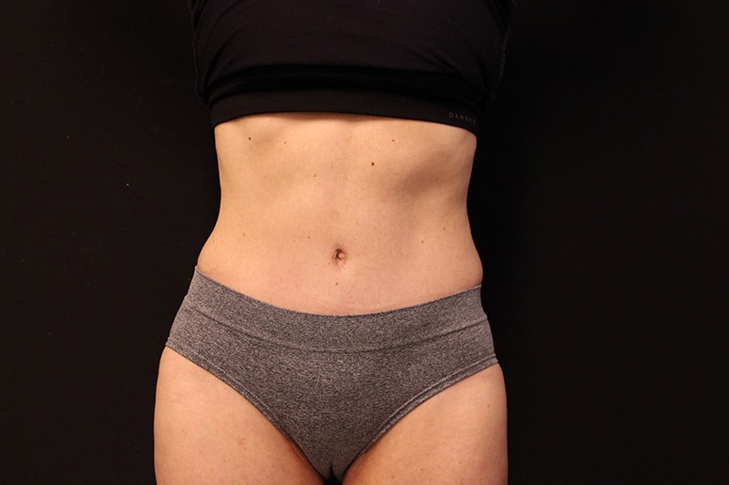 Tummy Tuck Before & After Image