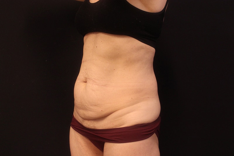 Tummy Tuck Before & After Image