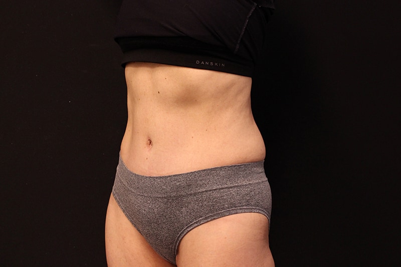 Tummy Tuck Before & After Image
