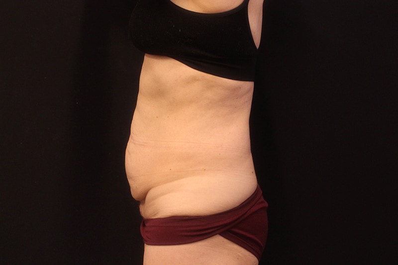 Tummy Tuck Before & After Image