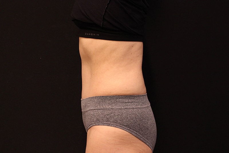 Tummy Tuck Before & After Image