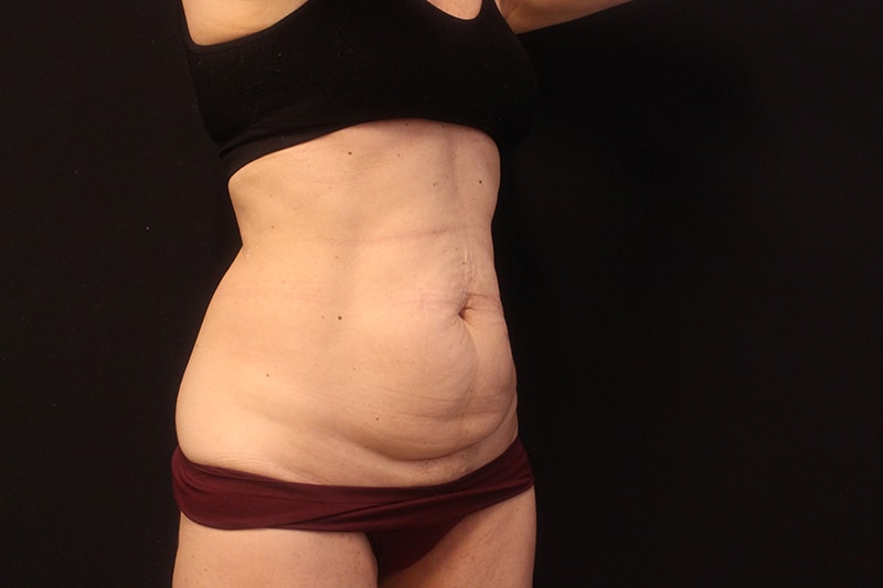 Tummy Tuck Before & After Image