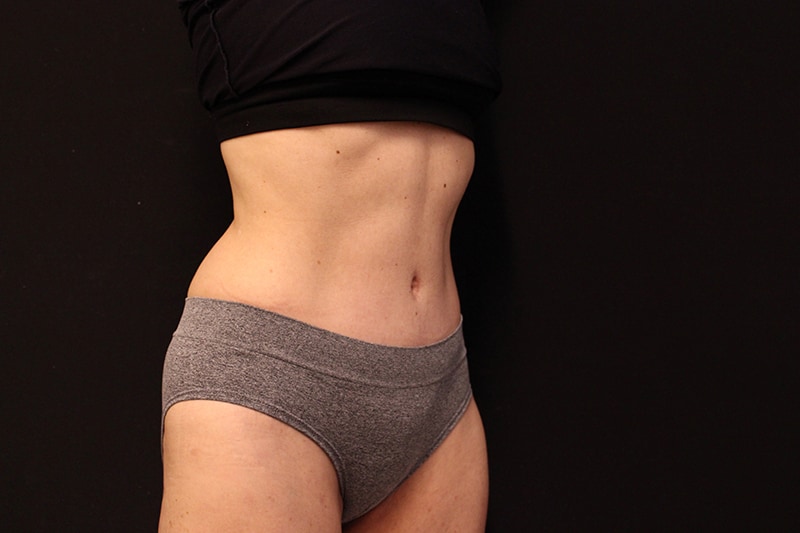 Tummy Tuck Before & After Image