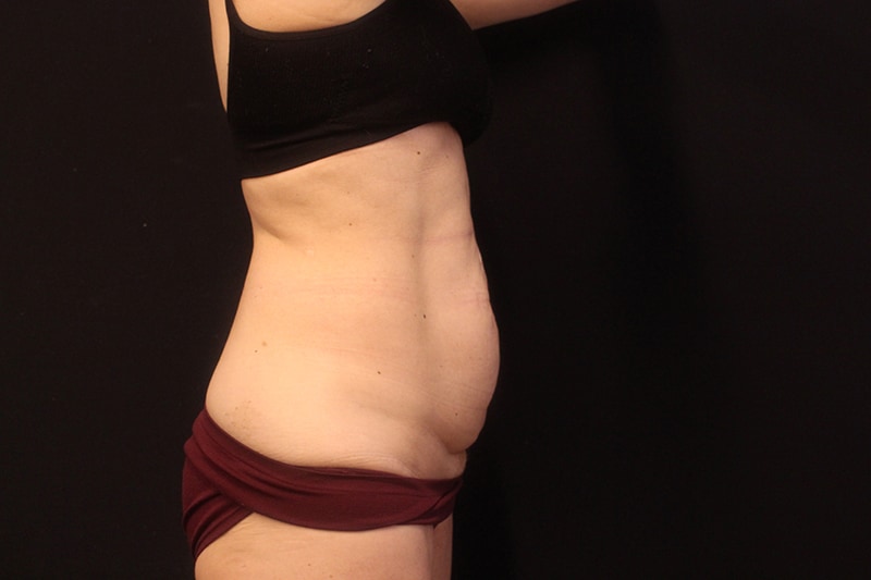 Tummy Tuck Before & After Image
